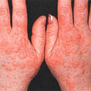 Alergie na rukách a prstoch s fotografiou
