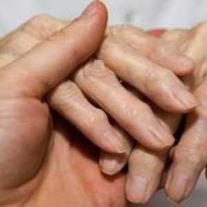 Artritída prstov: príznaky ochorenia a nevyhnutná liečba