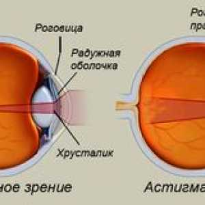 Astigmatizmus oka: čo to je, foto, liečba u dospelých