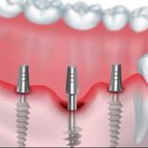 Bazálna implantácia: výhody bazálnej implantácie zubov