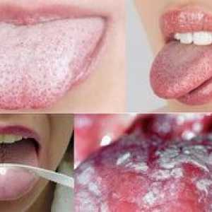 Biely povlak na jazyku: príčiny obštrukcie a liečby