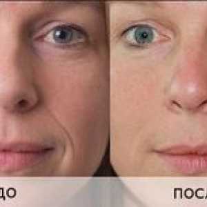 Neinjektívna biorevitalizácia tváre kyselinou hyalurónovou