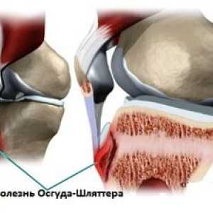Choroba kladiva a metódy liečby osguda kolenného kĺbu