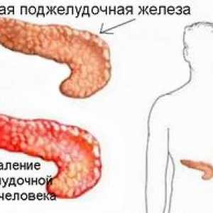 Choroby pankreasu: príznaky a liečba