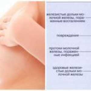 Hrudník na hrudi počas dojčenia: príčiny, symptómy a liečba