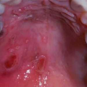 Chlorene v ústach: príčiny a liečba