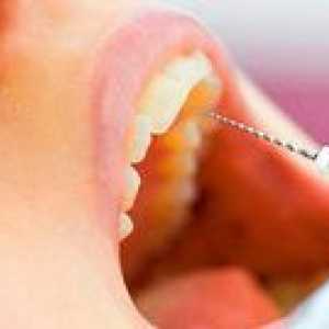Je bolestivé odstrániť nerv z zuba?