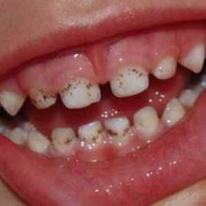 Čierny plak na zuby: príčiny vzhľadu a spôsoby eliminácie