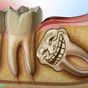 Čo robiť, ak rastie zub múdrosti a žalúdok bolí
