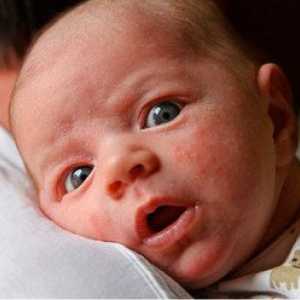 Čo robiť, ak má novorodenca vyrážku na tvári