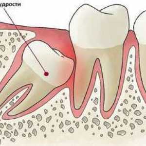 Čo robiť po múdrosti extrakcie zubov