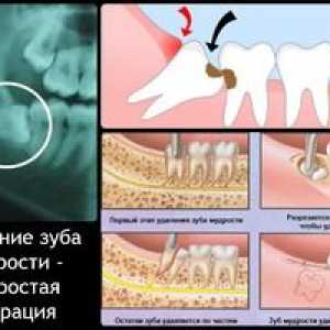 Čo robiť po extrakcii zubov: potrebné odporúčania
