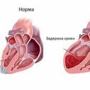 Čo to je - astma srdca, príznaky a liečba