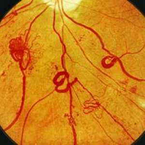 Čo je diabetická retinopatia: štádia, symptómy a liečba