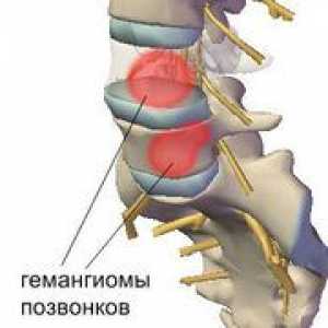 Čo to je - spinálny hemangióm, spôsoby jeho liečby