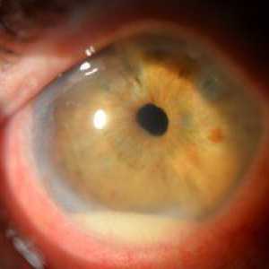 Čo je to - ochorenie očí iridocyklitis