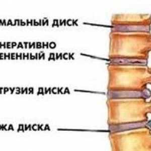 Čo to je - vyčnievanie chrbtových kotúčov a ako ich liečiť