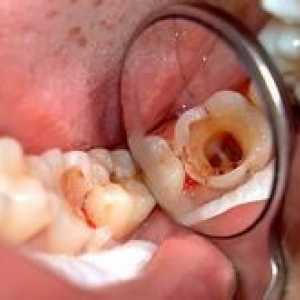 Čo je pulpitída: príznaky a liečba zubov?