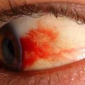 Čo je to retinopatia oka: typy, symptómy a liečba