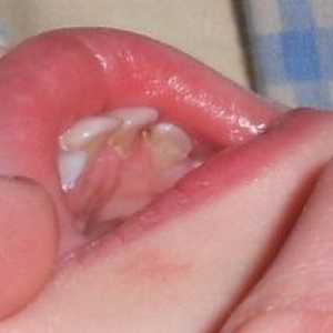 Čo mám robiť, ak je v mojom zube diera?