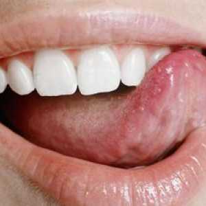 Čo sú biele rany v ústach?