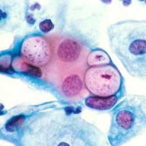 Čo je chlamydia trachomatis: príznaky a liečba chlamýdií