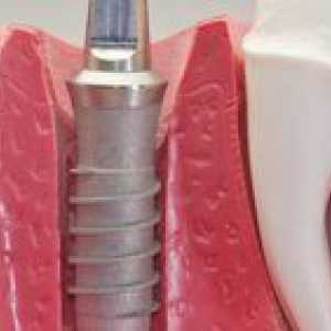 Čo je implantácia zubov a implantátov?