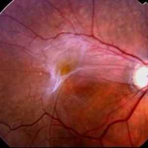 Čo je epiretinálna fibróza oka?