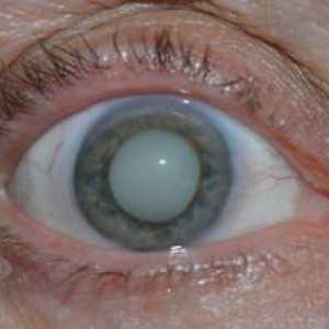 Čo je to očné šľachy, príznaky