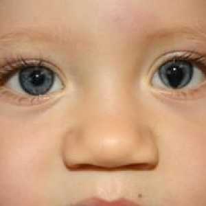 Čo je kolobóm oka dúhovky a očných viečok