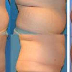 Čo je liposukcia: typy, plusy a mínusy procedúry