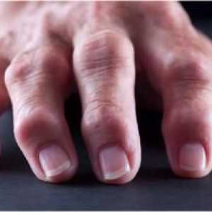 Čo je reumatoidná artritída?