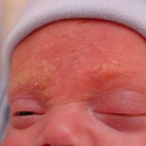 Čo je seboroická dermatitída u detí?