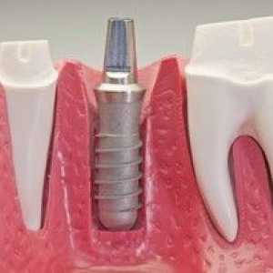 Čo sú zubné implantáty: typy a popis
