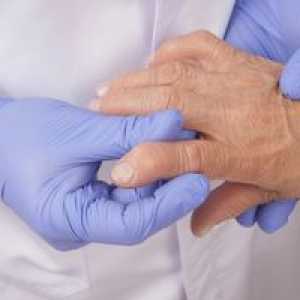 Čo je ochorenie artritída a ako ju liečiť