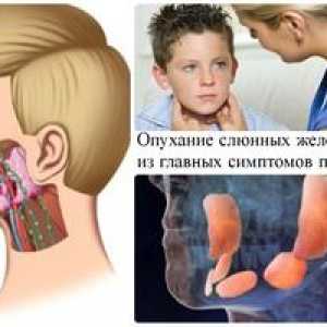 Čo choroba mumps epidémie: príznaky a liečba