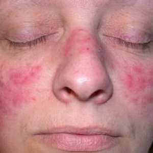 Demodikóza na tvári u žien: príznaky, fotky choroby