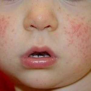 Dermatitída u dieťaťa: hlavné príčiny, liečebné metódy a fotografie