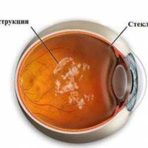 Zničenie sklovca v oku: príčiny, symptómy, liečba