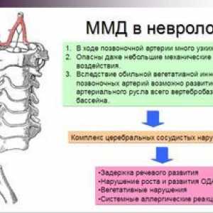Diagnóza neurologa mmd (minimálna dysfunkcia mozgu)