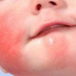 Diatéza na tvári dieťaťa: typy, popis, liečba a fotografie