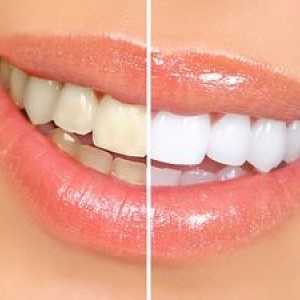 Domáce systémy na bielenie zubov