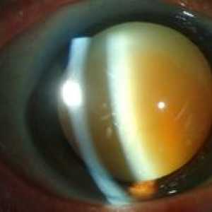 Phakoskleróza očných šošoviek: ako liečiť a čo je to?