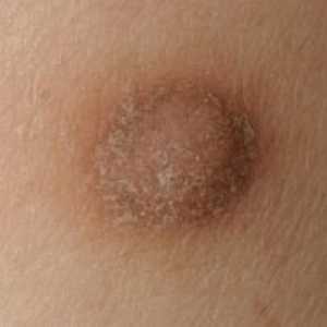 Fibróm kože: čo to je, príčiny jeho výskytu