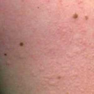 Foto alergickej vyrážky u detí