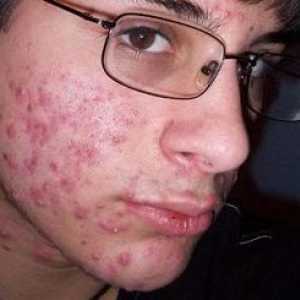 Foto akné na tvári: príčiny a liečba