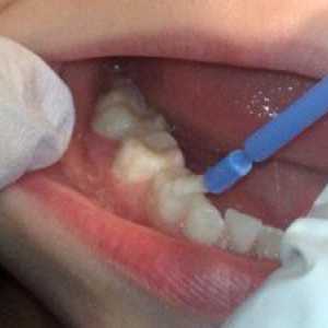 Fluoridácia zubov u detí - záruka zdravého uhryznutia