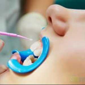 Fluoridácia zubov u detí: dávka, cena