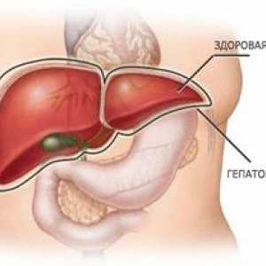 Hepatomegália pečene: čo je a ako sa s ňou liečiť