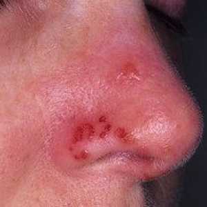 Herpes na nos: metódy na liečbu prechladnutia, foto